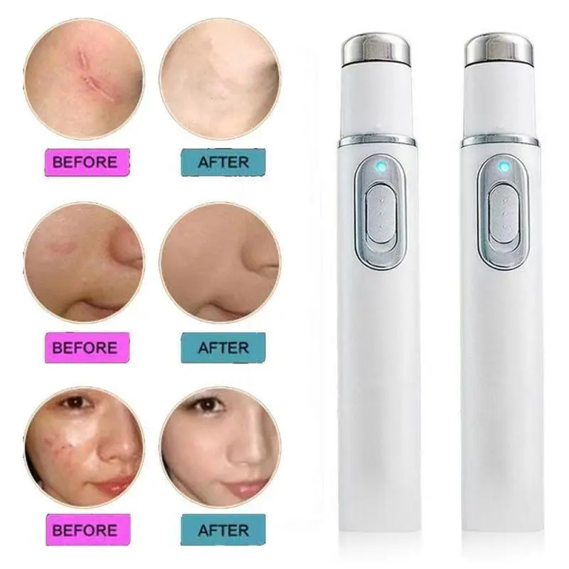 Portable Blue Light Acne Removal Pen – Sleek, Fragrance-Free Skin Therapy Tool - Image 4